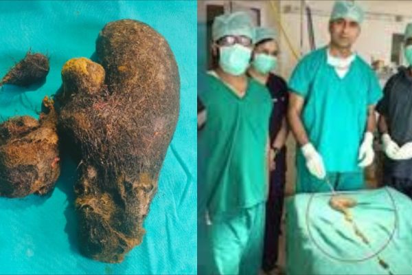 14 साल की बच्ची के पेट से निकला 3 किलो बालों का गुच्छा, डॉक्टर्स भी रह गए हैरान!